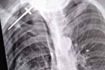 Radiografia bărbatului înjunghiat