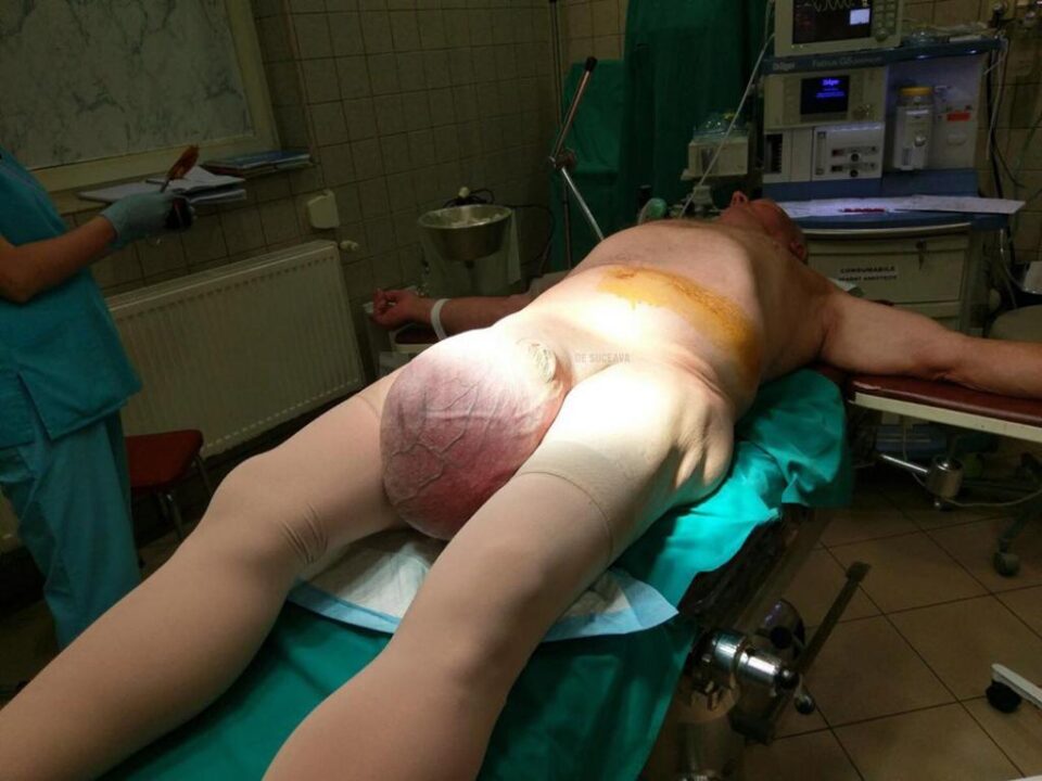 Hernie gigantică, veche de 15 ani