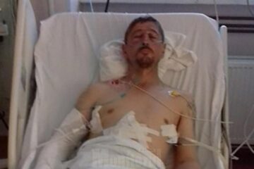 Starea de sănătate gravă a lui Gavriluț Flocea a necesitat intervenții chirurgicale complexe, acesta având, printre altele, o ruptură de rinichi