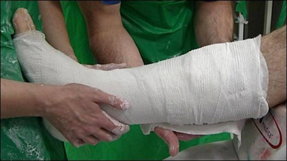 Picior în ghips. Foto: socinro.me