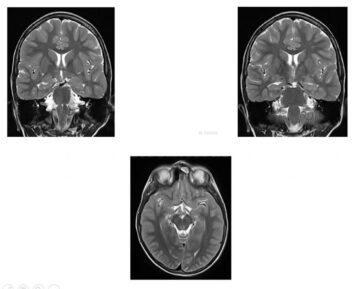 Formă de epilepsie care apare un caz la un milion, diagnosticată la un copil, de dr. Anna Miron, de la Centrul de Epilepsie al Spitalului de Urgență Suceava