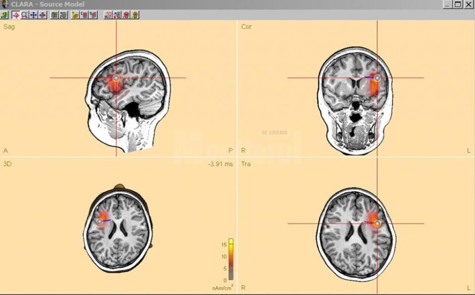 Dr. Anna Miron prezintă cele patru focare de epilepsie ale fetiței