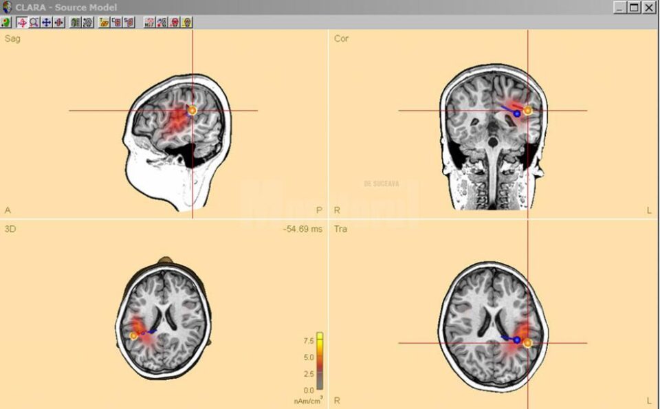 Dr. Anna Miron prezintă cele patru focare de epilepsie ale fetiței