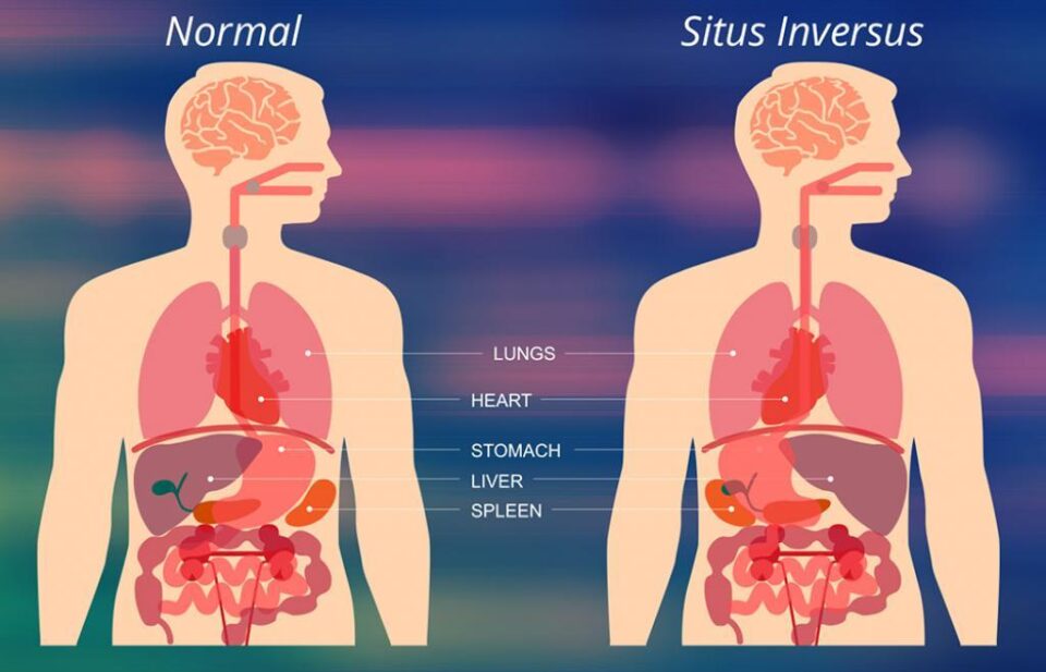 Situs inversus. Foto: Curiosity