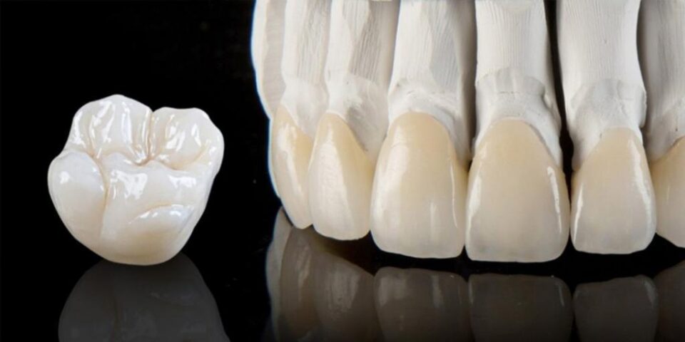 Care varianta este mai buna dintre coroana metalo-ceramica si coroana din zirconiu?