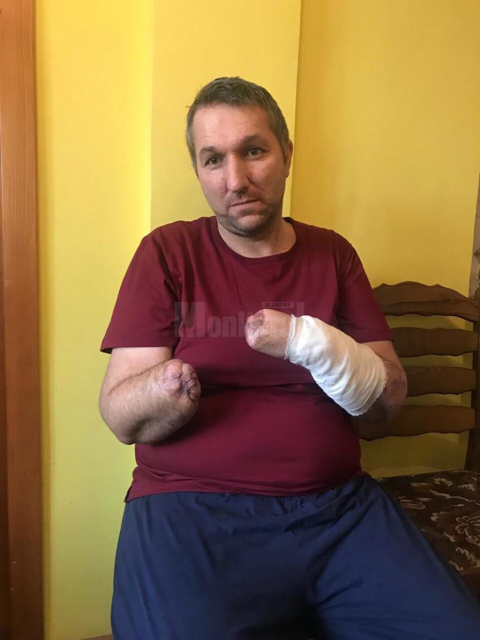 Constantin Cazac, în vârstă de 40 de ani, cu ambele mâini amputate, în urma unui accident, are nevoie urgent de două proteze