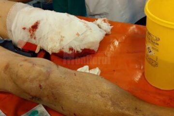 Tânărul care a suferit cumplita amputație a fost salvat de medici