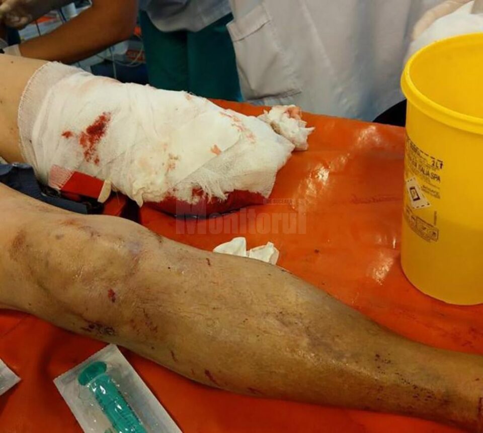 Tânărul care a suferit cumplita amputație a fost salvat de medici
