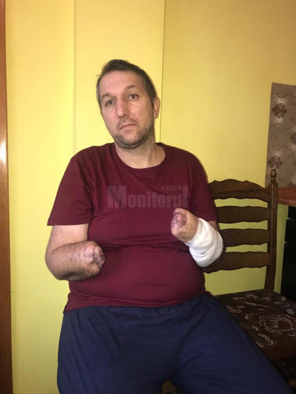 Constantin Cazac, în vârstă de 40 de ani, cu ambele mâini amputate, în urma unui accident, are nevoie urgent de două proteze