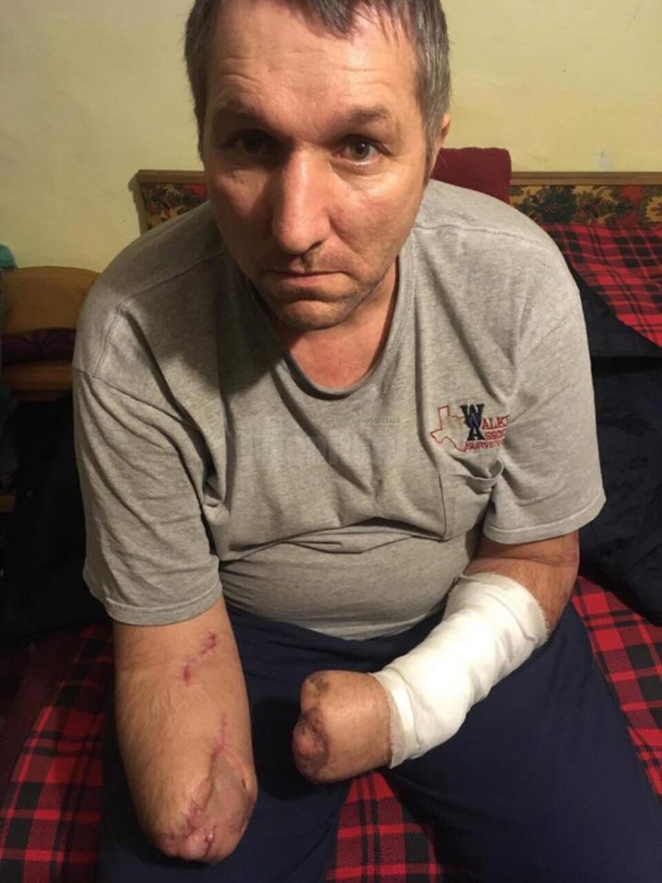 Bărbatul din Bădeuți cu ambele mâini amputate are nevoie în continuare de ajutor pentru a-și cumpăra proteze