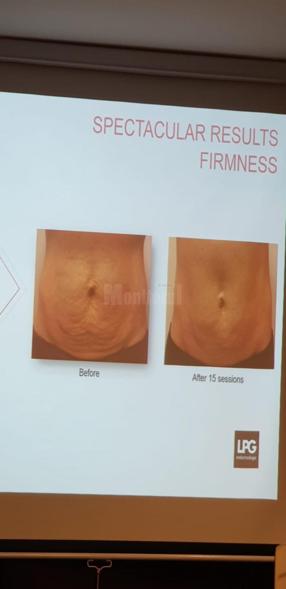 Tratament de slăbire și remodelare LPG – ultima generație