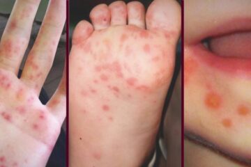 Boala „Gură-mână-picior” Foto: sfaturi medicale