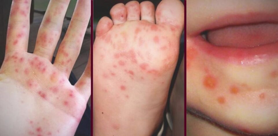 Boala „Gură-mână-picior” Foto: sfaturi medicale