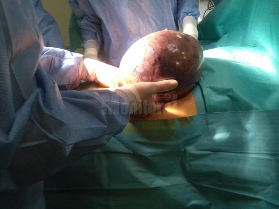 Momentul extracției tumorii