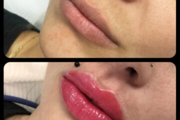 Măriri de buze și proceduri de înfrumusețare, efectuate ilegal în Suceava de o clinică din Capitală