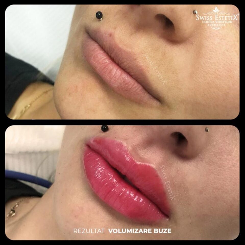Măriri de buze și proceduri de înfrumusețare, efectuate ilegal în Suceava de o clinică din Capitală