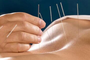 Acupunctură