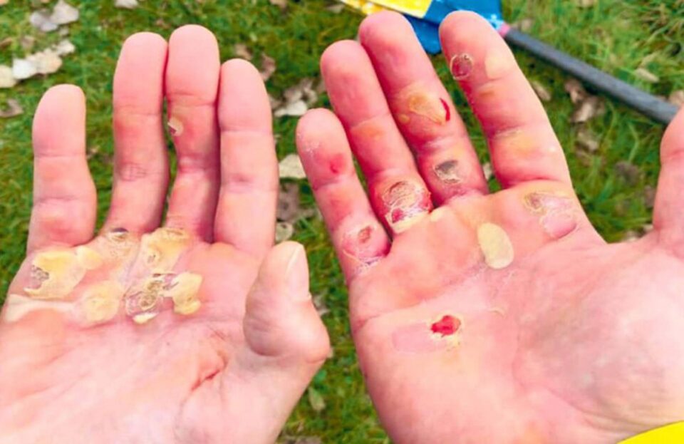 Palmele sângerânde ale celor doi campioni vorbesc despre sacrificiul lor în sport. Foto gsp.ro Palmele sângerânde ale celor doi campioni vorbesc despre sacrificiul lor în sport. Foto gsp.ro