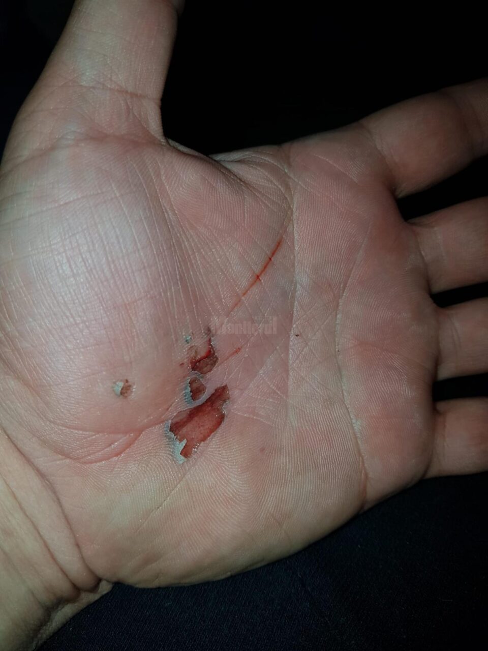 Julituri în urma căzăturii