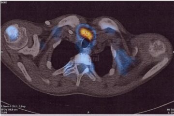 Evaluarea glandelor paratiroide s-a realizat cu ajutorul medicinei nucleare, prin SPECT-CT