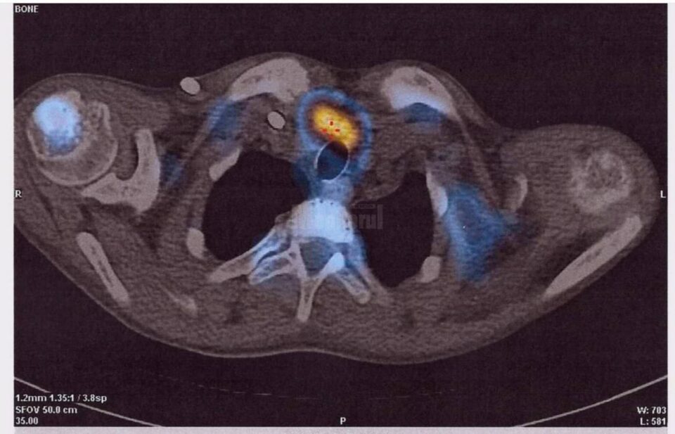 Evaluarea glandelor paratiroide s-a realizat cu ajutorul medicinei nucleare, prin SPECT-CT Evaluarea glandelor paratiroide s-a realizat cu ajutorul medicinei nucleare, prin SPECT-CT