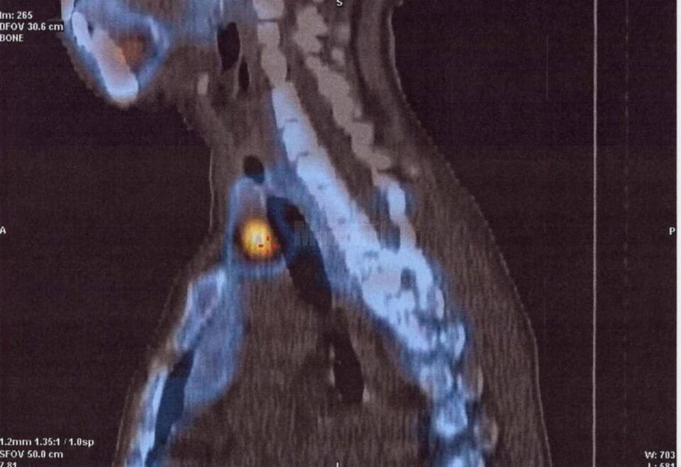Evaluarea glandelor paratiroide s-a realizat cu ajutorul medicinei nucleare, prin SPECT-CT