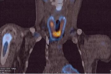 Imagini PET CT