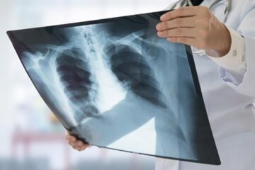 Radiografie a plămânilor. Foto sfatulmedicului.ro