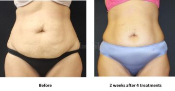 Before-after-V-Form