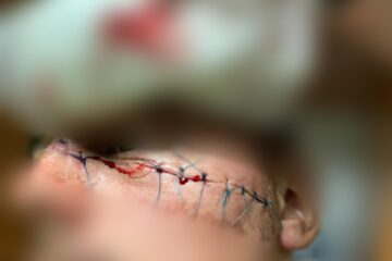 Un atac feroce, o tăietură care va rămâne pe viață pe fața tânărului polițist pentru care putea fi însă mult mai rău