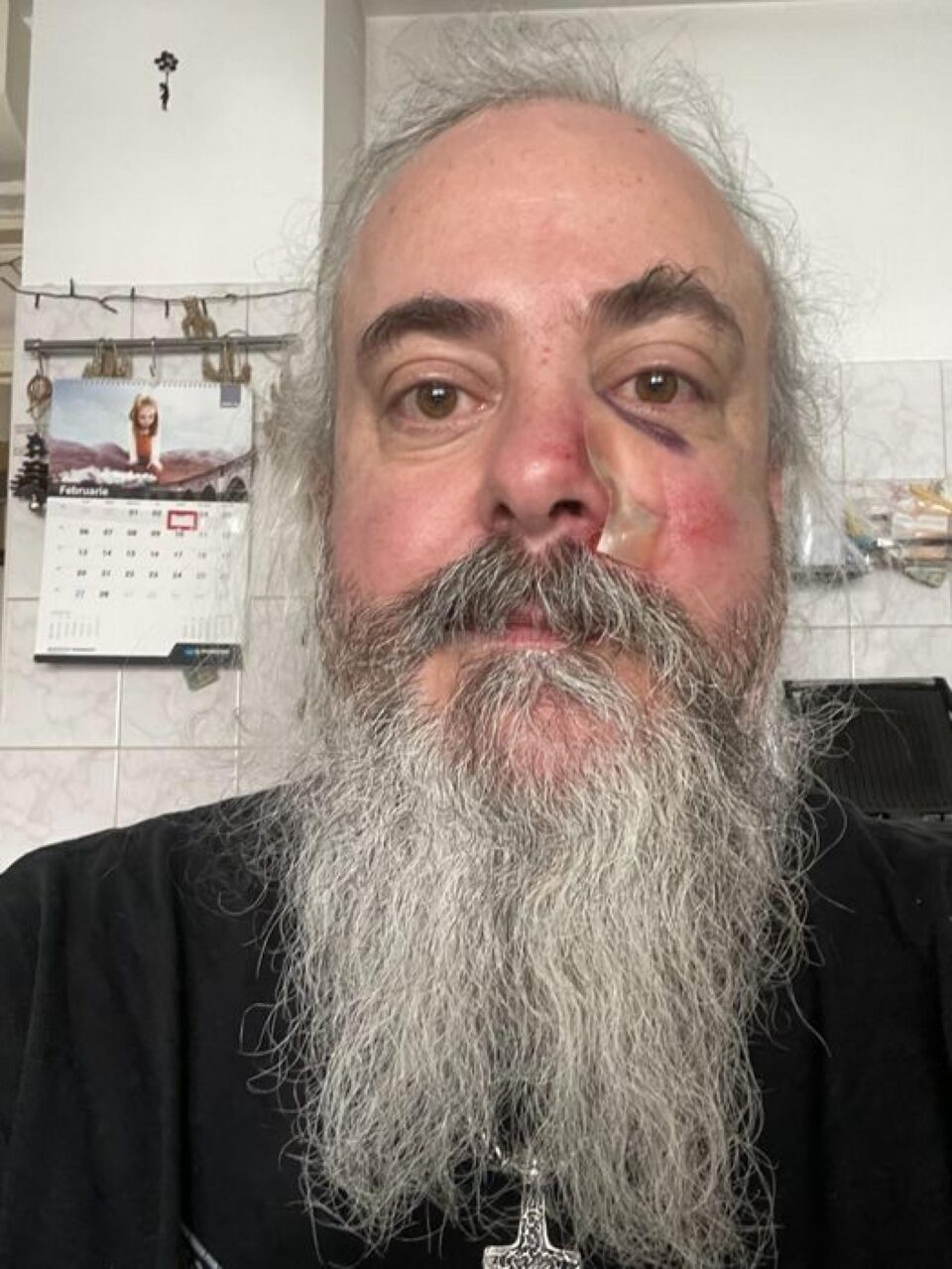 Florin ”Crivăț” Țibu după agresiunea din noaptea de vineri spre sâmbătă