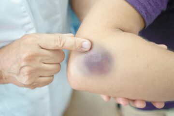 Hemofilia este o boală rară care lasă vânătăi. Foto digi24.ro