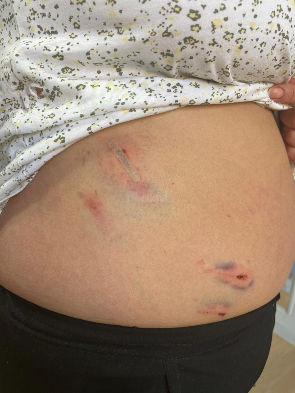 Femeia mușcată de câini marți dimineață