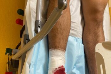 Încă un tânăr accidentat după ce a alunecat pe gresia udă la ștrandul de la Ițcani