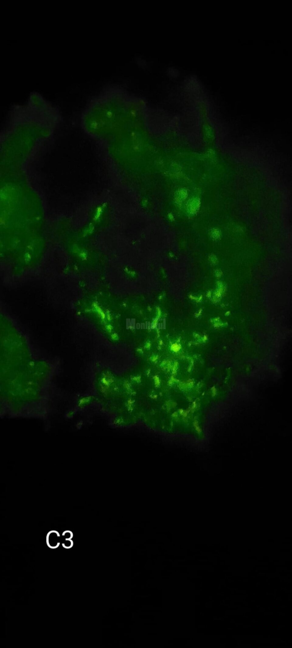 Imunoflorescenta ce releva depunere de C3 la nivelul capilarelor glomerulare