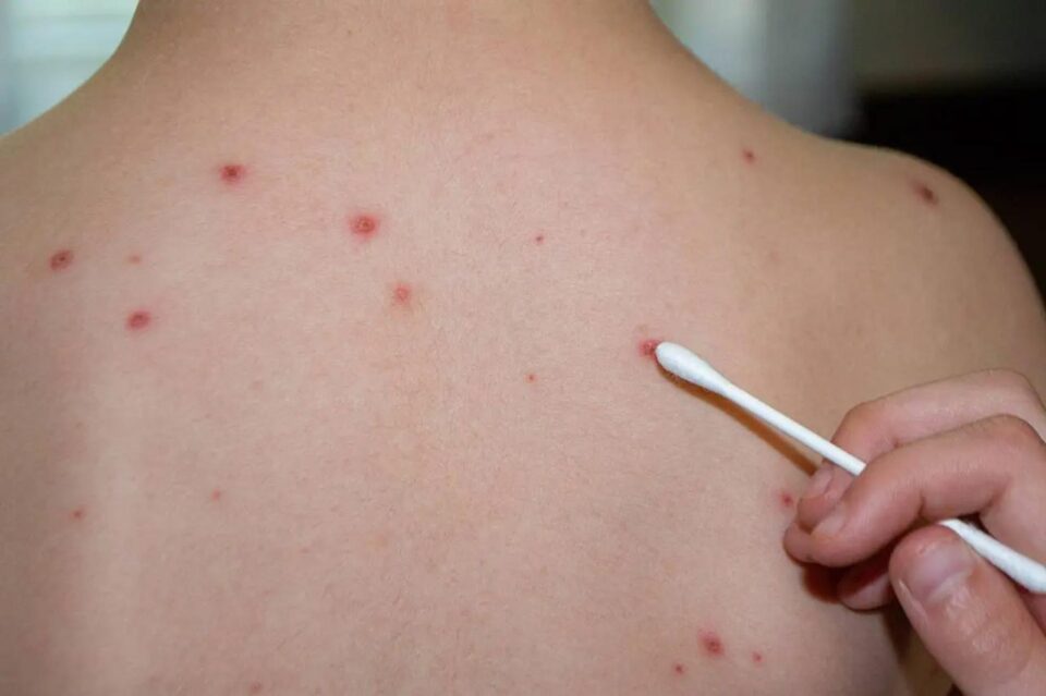 Aproape 160 de cazuri de rujeolă în județul Suceava, de la începutul acestui an Foto: bioclinica.ro Aproape 160 de cazuri de rujeolă în județul Suceava, de la începutul acestui an Foto: bioclinica.ro