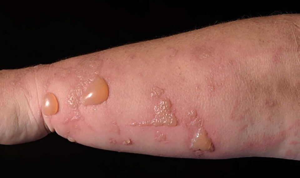 Fitofotodermatită Sursa foto HEALTH JADE