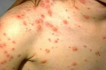 Epidemie de rujeola in Romania. Foto pressalert.ro
