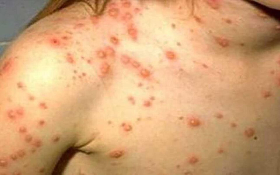 Epidemie de rujeola in Romania. Foto pressalert.ro