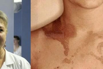 Doctorul Cristina Ionescu, medic primar dermatolog, explică Dermatita Berloque