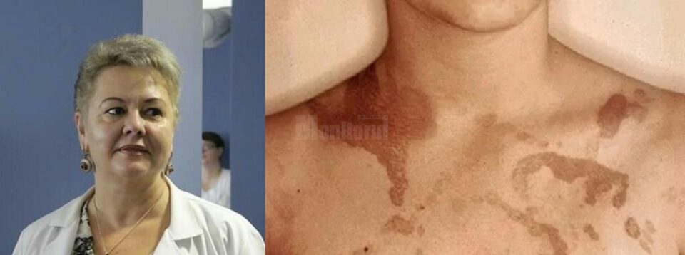 Doctorul Cristina Ionescu, medic primar dermatolog, explică Dermatita Berloque