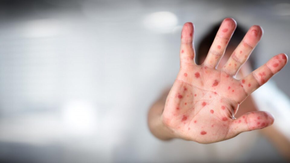 Mai multe de jumătate din cele peste 1.000 de cazuri de rujeolă din județ au avut nevoie de spitalizare Mai multe de jumătate din cele peste 1.000 de cazuri de rujeolă din județ au avut nevoie de spitalizare