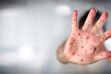 Mai multe de jumătate din cele peste 1.000 de cazuri de rujeolă din județ au avut nevoie de spitalizare