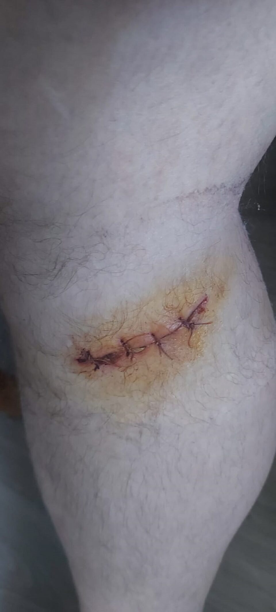 A doua rana suferita de Florin Zuziac