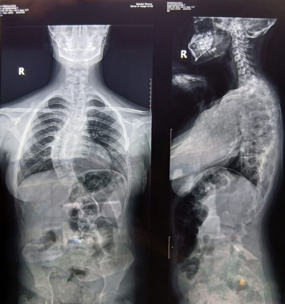 Sara Sofronia, în vârstă de 13 ani, are nevoie de o operație care îi poate schimba viața. Ea suferă de o deformare progresivă a coloanei vertebrale